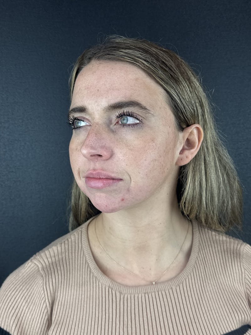 Chin Filler Before & After Gallery - Patient 209240 - Image 8