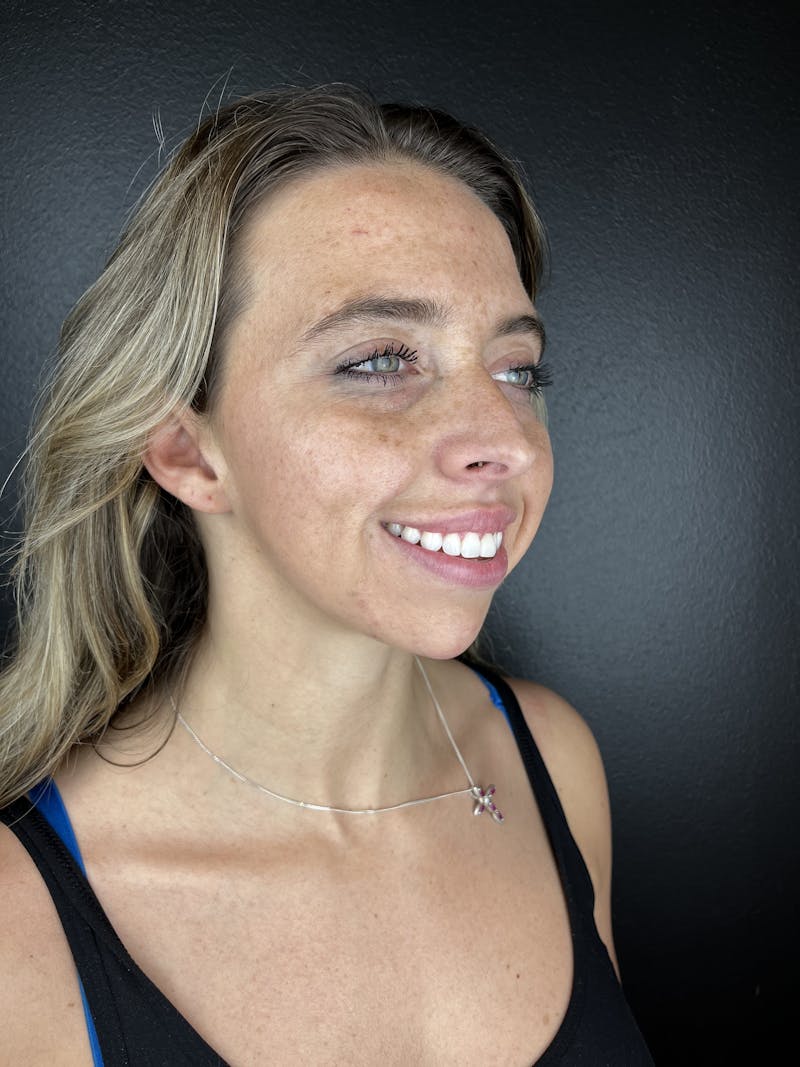Chin Filler Before & After Gallery - Patient 209240 - Image 2