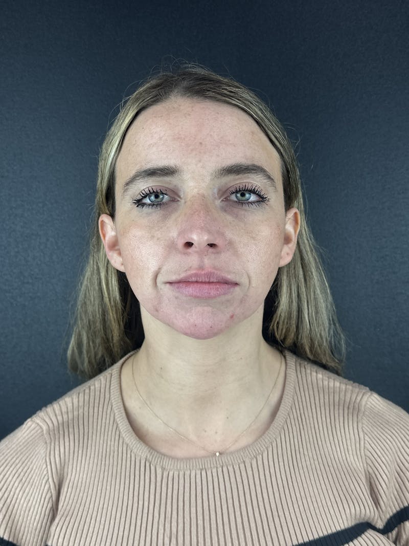 Chin Filler Before & After Gallery - Patient 209240 - Image 4