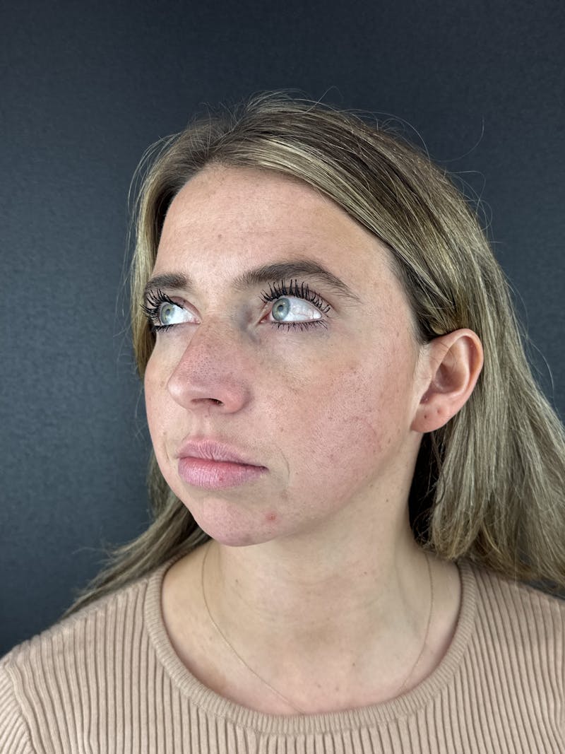 Chin Filler Before & After Gallery - Patient 209240 - Image 7