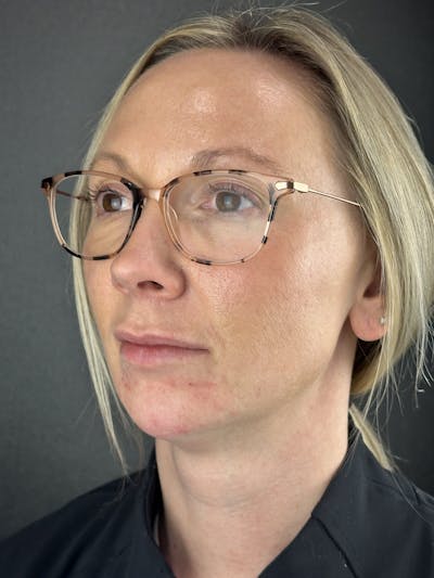 Chin Filler Before & After Gallery - Patient 632529 - Image 2