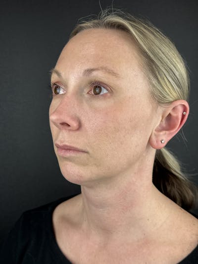 Chin Filler Before & After Gallery - Patient 632529 - Image 1