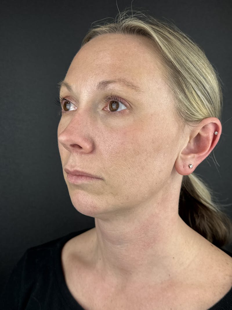 Chin Filler Before & After Gallery - Patient 632529 - Image 1