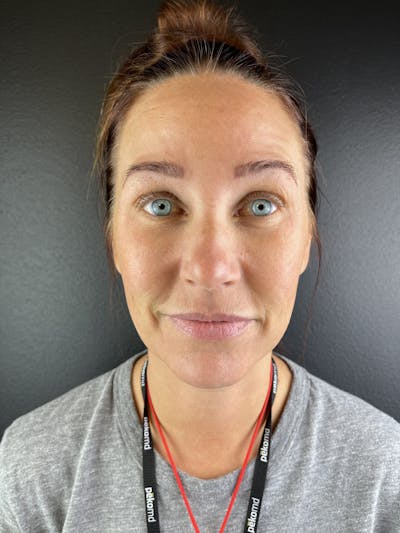 Chin Filler Before & After Gallery - Patient 403572 - Image 1