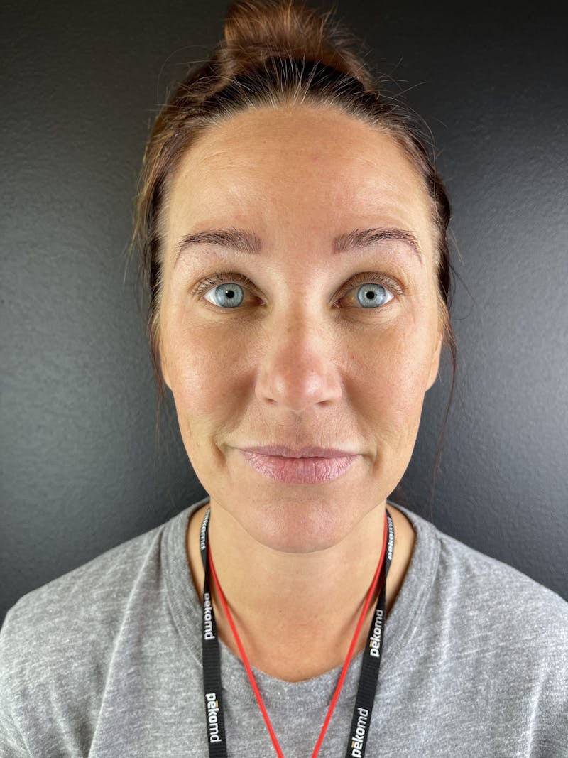 Chin Filler Before & After Gallery - Patient 403572 - Image 1
