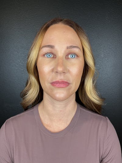 Chin Filler Before & After Gallery - Patient 403572 - Image 2