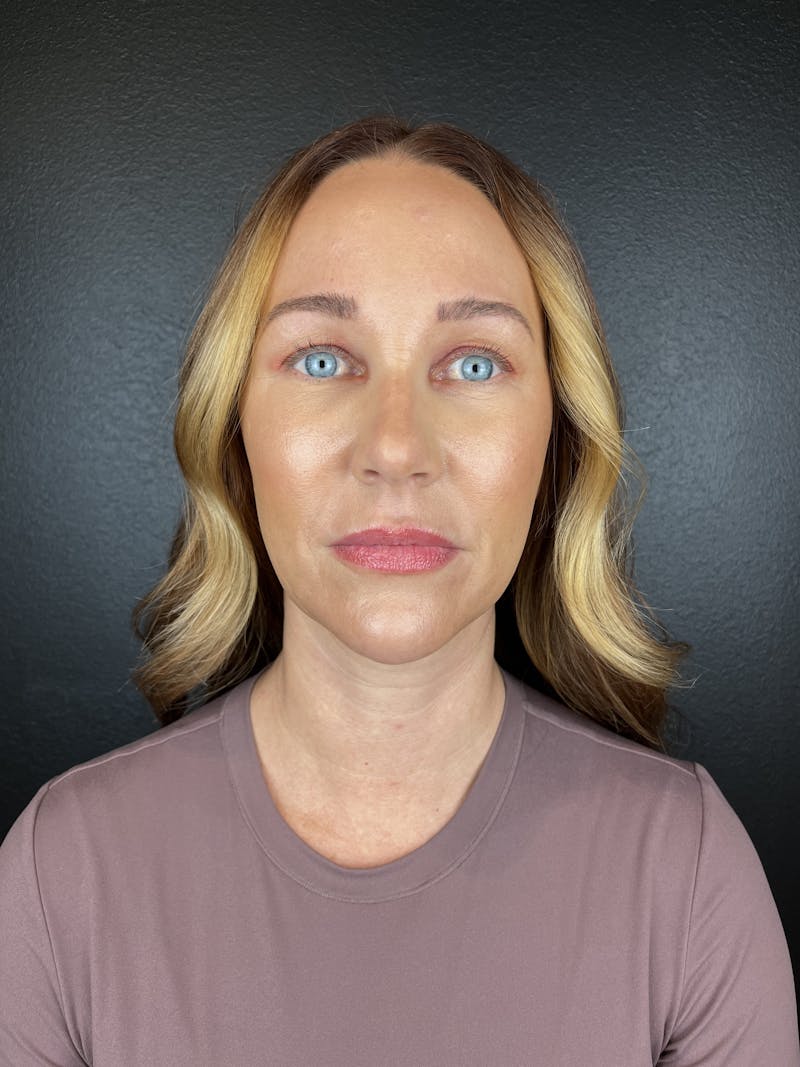 Chin Filler Before & After Gallery - Patient 403572 - Image 2