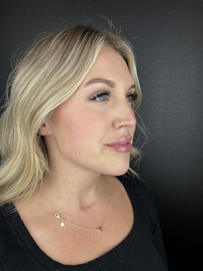 Chin Filler Before & After Gallery - Patient 397345 - Image 2