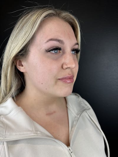 Chin Filler Before & After Gallery - Patient 397345 - Image 1