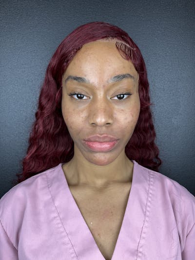 Cheek Filler Before & After Gallery - Patient 107568 - Image 2