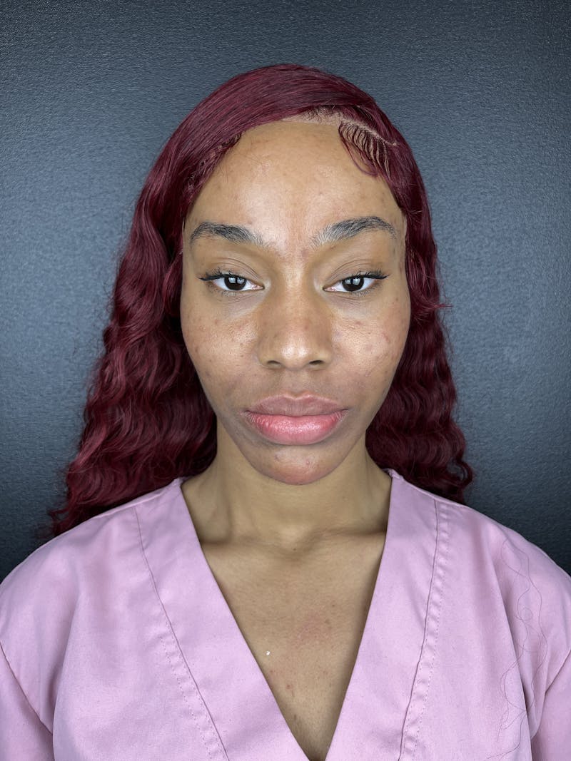 Cheek Filler Before & After Gallery - Patient 107568 - Image 2