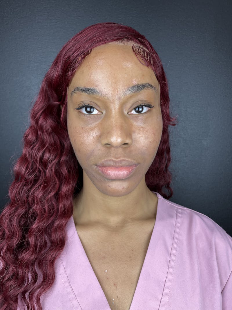 Cheek Filler Before & After Gallery - Patient 107568 - Image 1