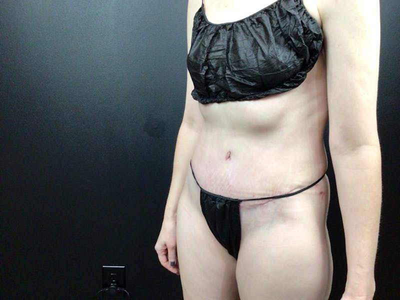 Tummy Tuck Before & After Gallery - Patient 794493 - Image 2