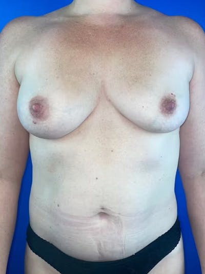 Breast Augmentation Before & After Gallery - Patient 219532 - Image 1
