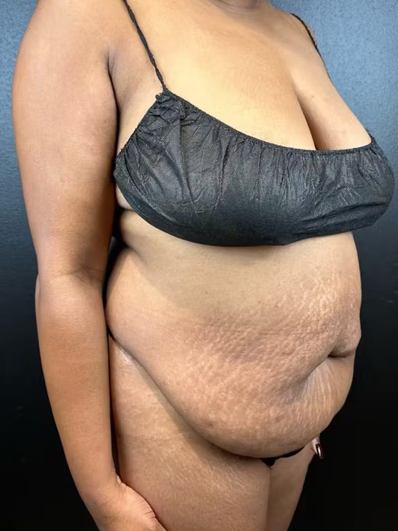 Tummy Tuck Before & After Gallery - Patient 111300 - Image 1