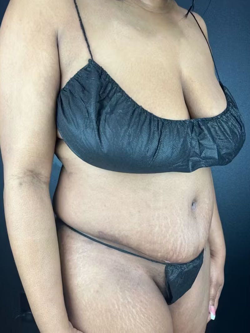 Tummy Tuck Before & After Gallery - Patient 111300 - Image 2