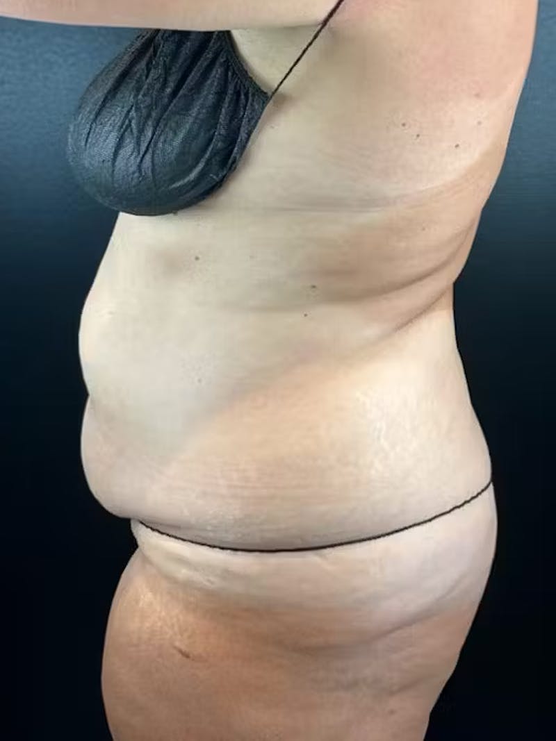 Tummy Tuck Before & After Gallery - Patient 582664 - Image 1