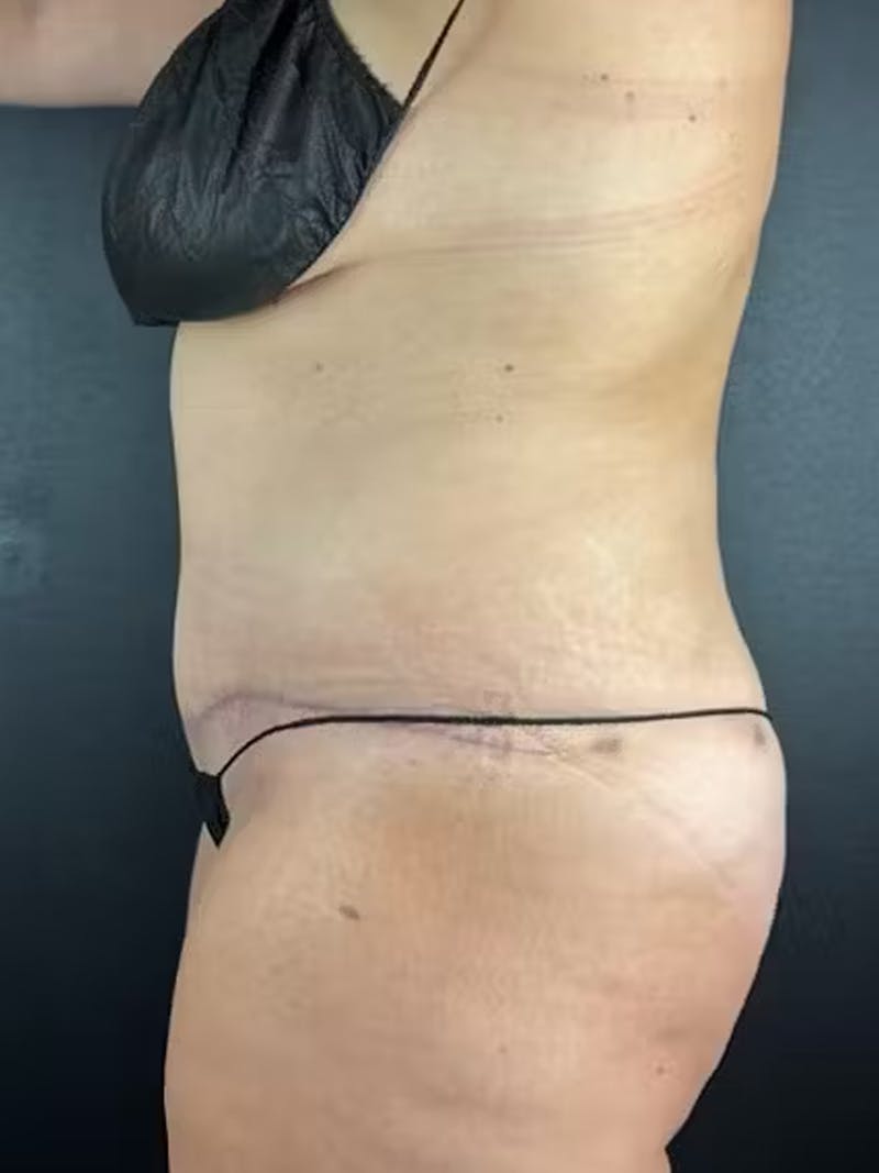 Tummy Tuck Before & After Gallery - Patient 582664 - Image 2