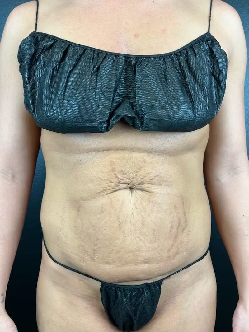 Tummy Tuck Before & After Gallery - Patient 393520 - Image 1