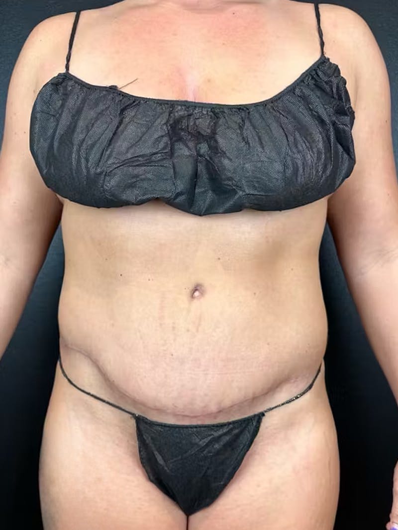 Tummy Tuck Before & After Gallery - Patient 393520 - Image 2