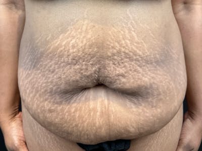 Tummy Tuck Before & After Gallery - Patient 111300 - Image 1
