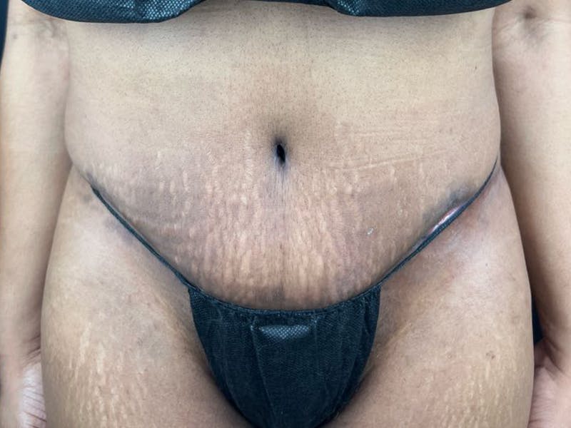 Tummy Tuck Before & After Gallery - Patient 111300 - Image 2