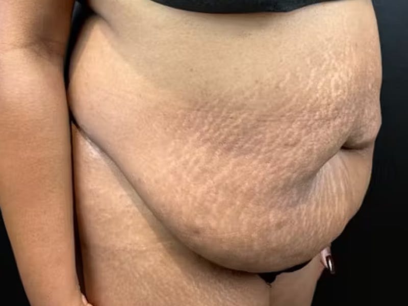 Tummy Tuck Before & After Gallery - Patient 111300 - Image 3