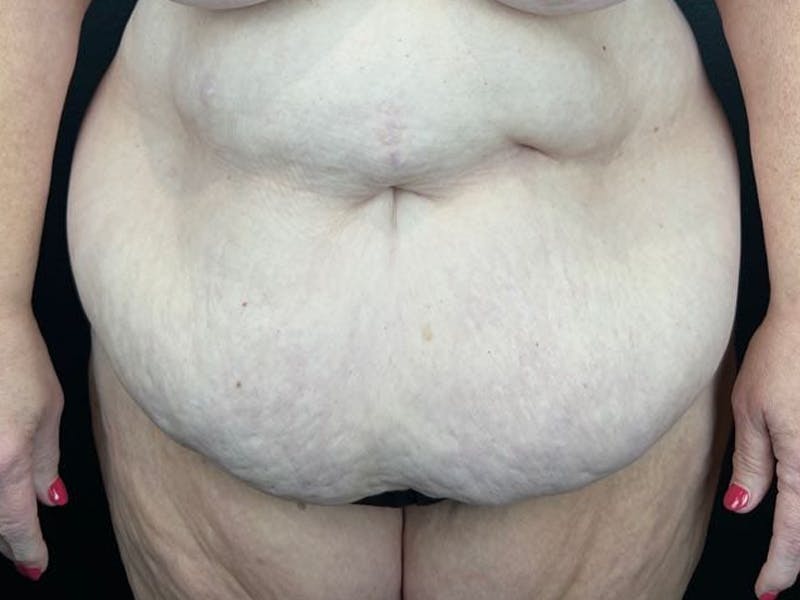 Tummy Tuck Before & After Gallery - Patient 292786 - Image 1