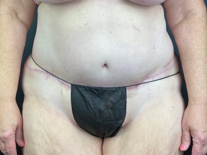 Tummy Tuck Before & After Gallery - Patient 292786 - Image 2
