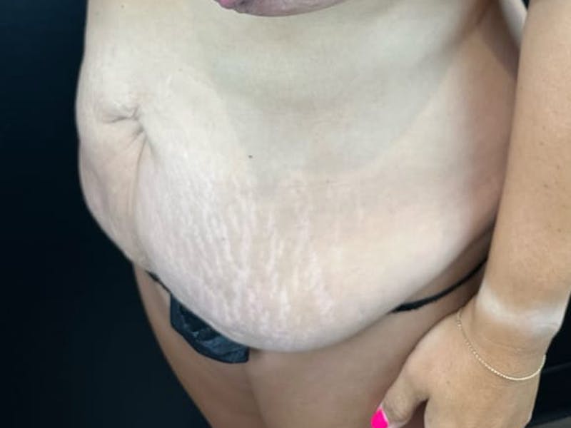 Tummy Tuck Before & After Gallery - Patient 898798 - Image 1