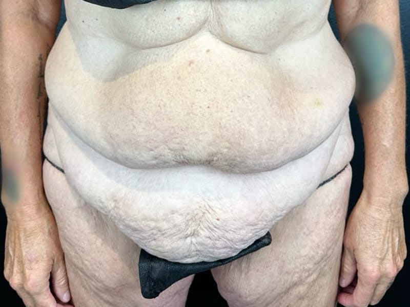 Tummy Tuck Before & After Gallery - Patient 716513 - Image 1