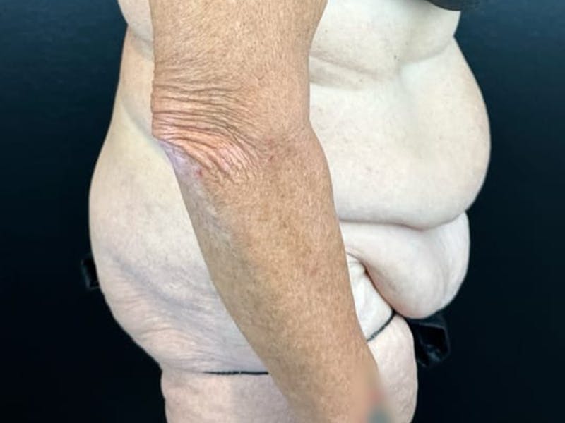 Tummy Tuck Before & After Gallery - Patient 716513 - Image 3