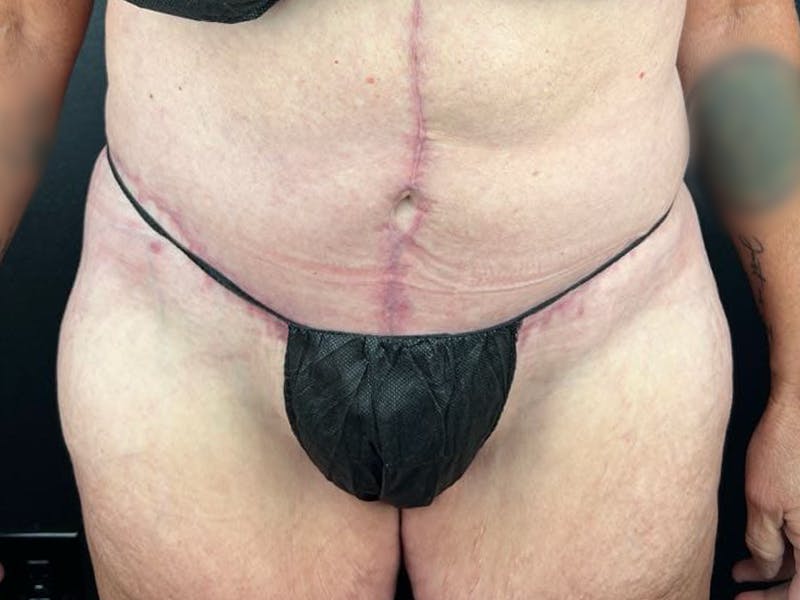 Tummy Tuck Before & After Gallery - Patient 716513 - Image 2