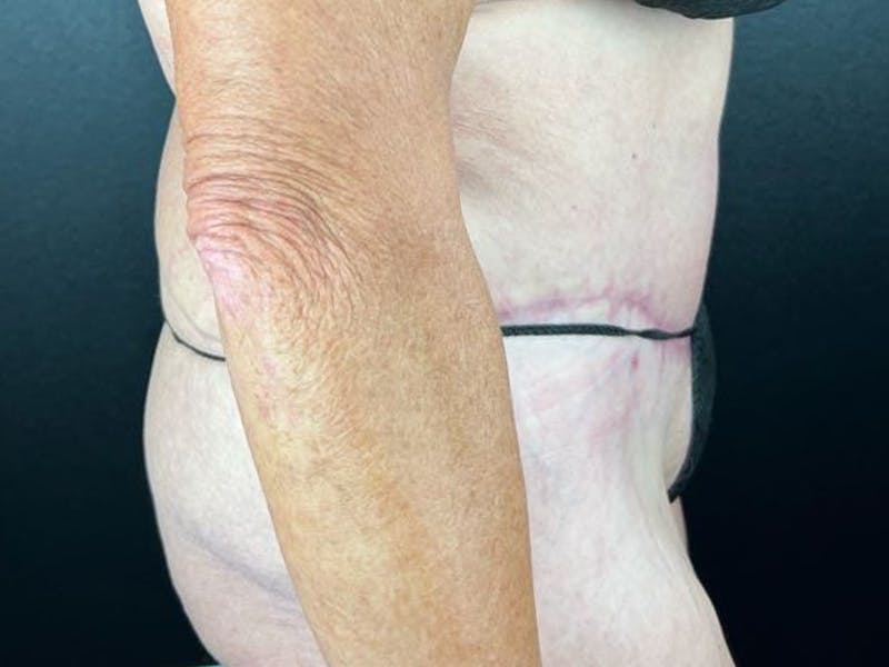 Tummy Tuck Before & After Gallery - Patient 716513 - Image 4