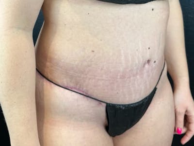 Tummy Tuck Before & After Gallery - Patient 807161 - Image 2