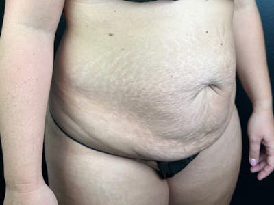 Tummy Tuck Before & After Gallery - Patient 807161 - Image 1