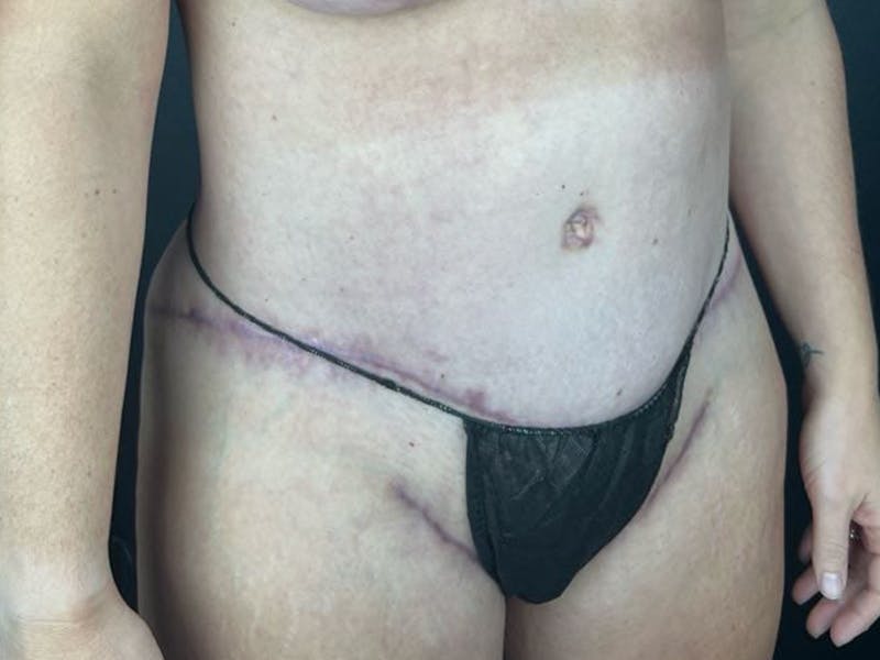 Tummy Tuck Before & After Gallery - Patient 239546 - Image 2