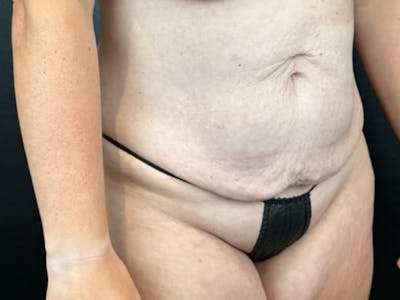 Tummy Tuck Before & After Gallery - Patient 239546 - Image 1