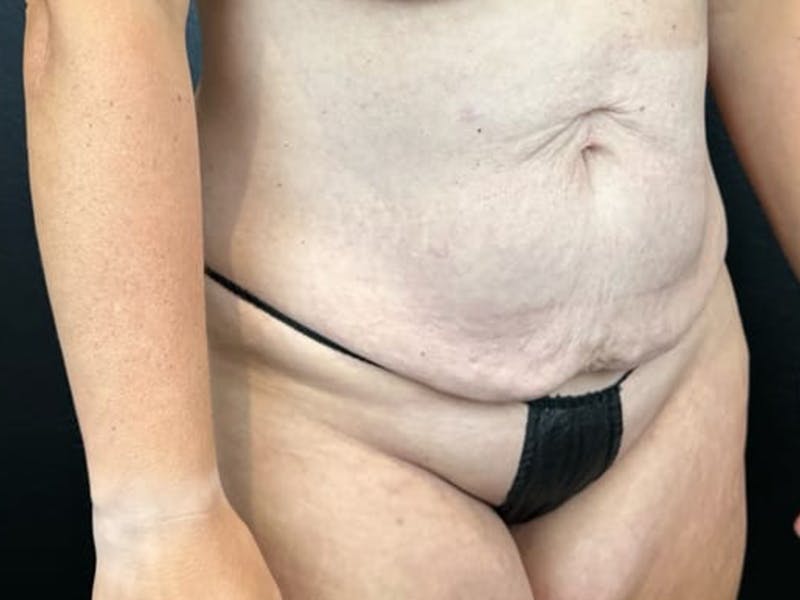 Tummy Tuck Before & After Gallery - Patient 239546 - Image 1