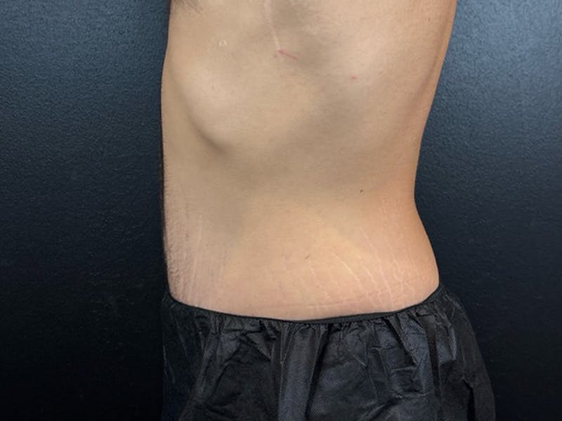 Tummy Tuck Before & After Gallery - Patient 176809 - Image 2