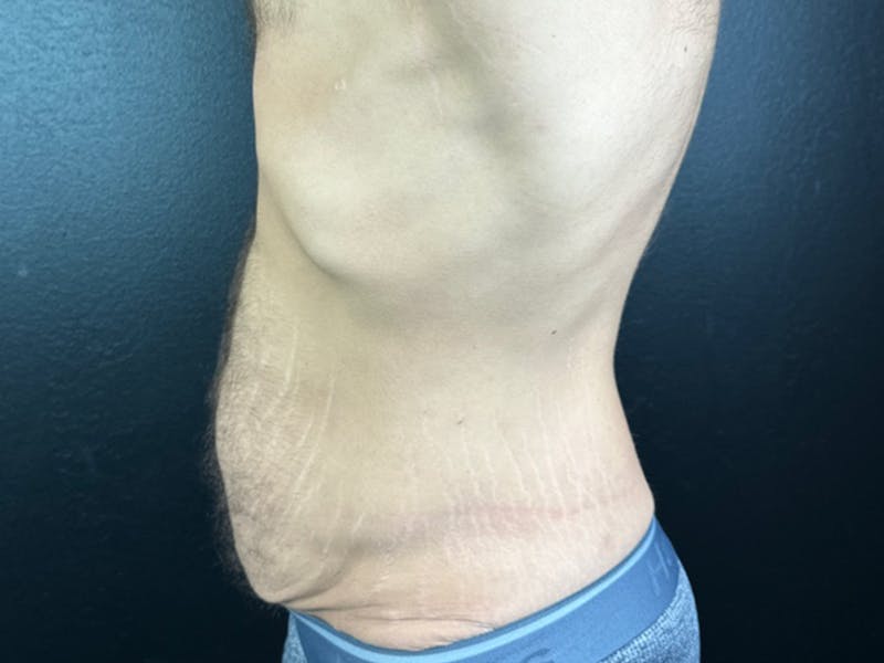 Tummy Tuck Before & After Gallery - Patient 176809 - Image 1