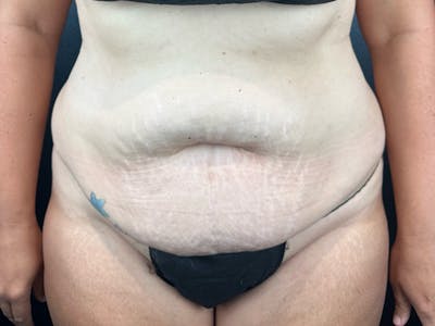Tummy Tuck Before & After Gallery - Patient 582664 - Image 1