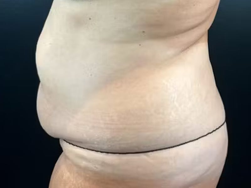 Tummy Tuck Before & After Gallery - Patient 582664 - Image 3