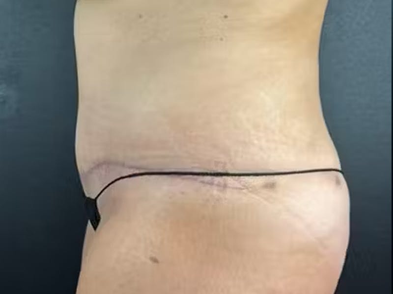 Tummy Tuck Before & After Gallery - Patient 582664 - Image 4