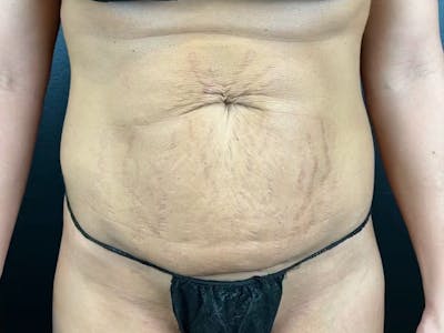 Tummy Tuck Before & After Gallery - Patient 393520 - Image 1