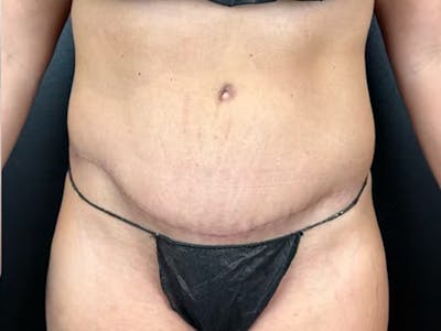 Tummy Tuck Before & After Gallery - Patient 393520 - Image 2
