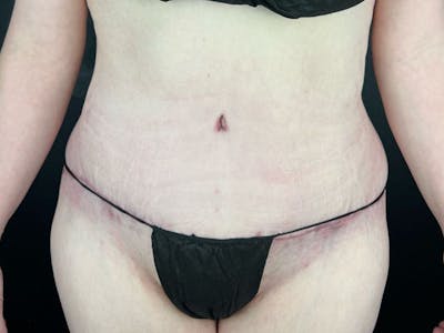 Tummy Tuck Before & After Gallery - Patient 663126 - Image 2