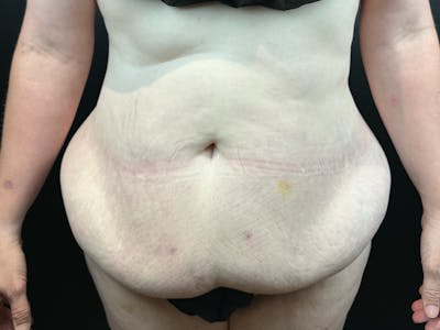 Tummy Tuck Before & After Gallery - Patient 663126 - Image 1