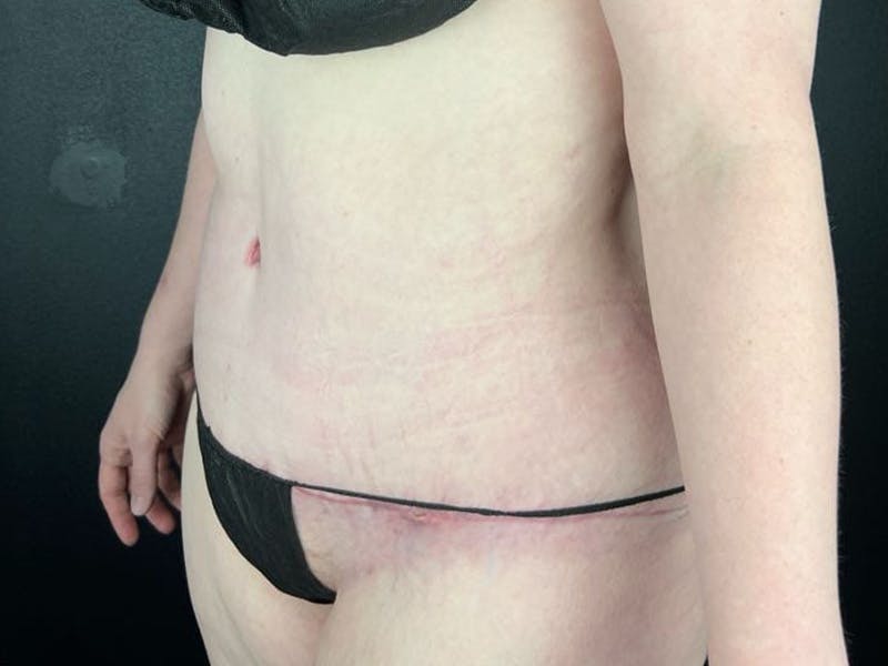 Tummy Tuck Before & After Gallery - Patient 663126 - Image 4