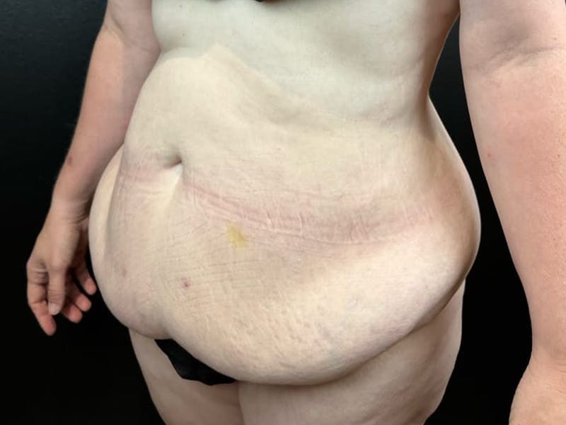 Tummy Tuck Before & After Gallery - Patient 663126 - Image 3